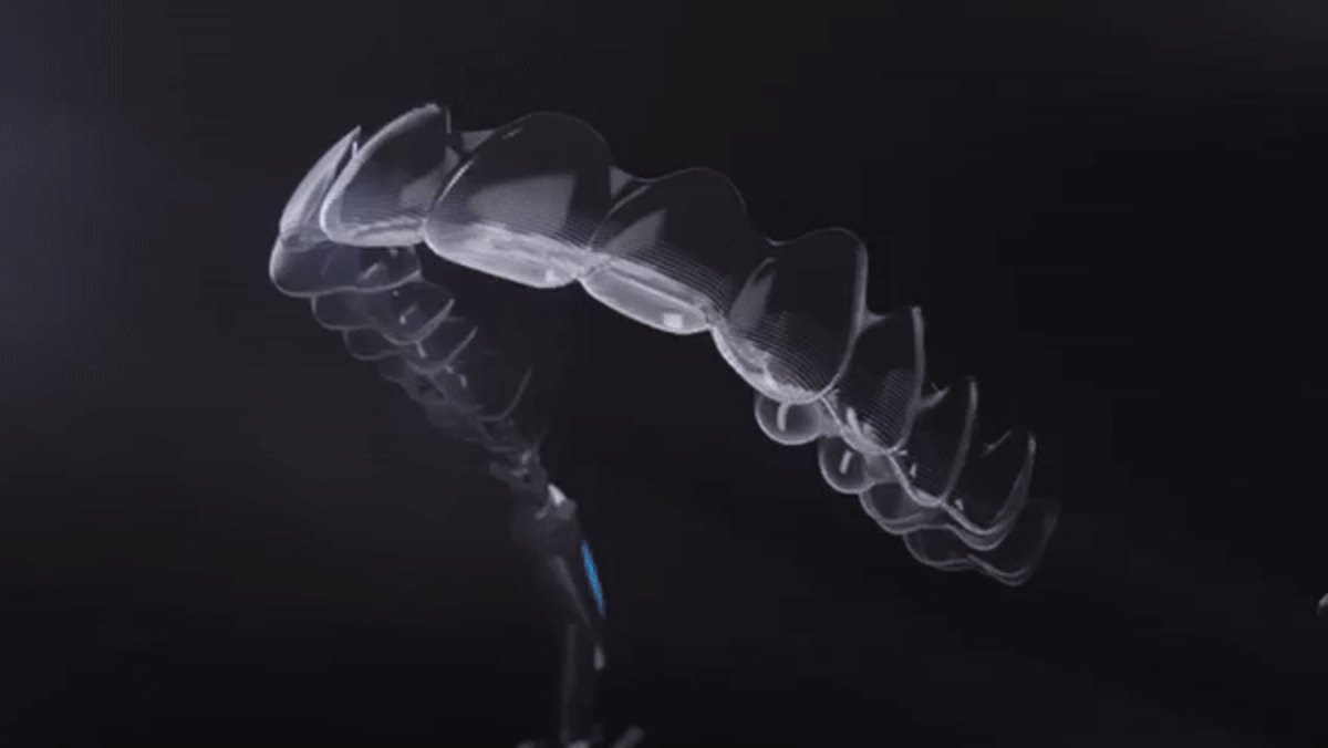 Simulation du déplacement progressif des dents avec des gouttières Invisalign